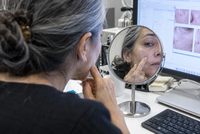 Milia vs Whiteheads: Can a Photo Tell the Difference?