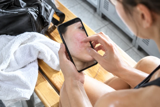 Dá para diferenciar rosácea de acne em uma foto?